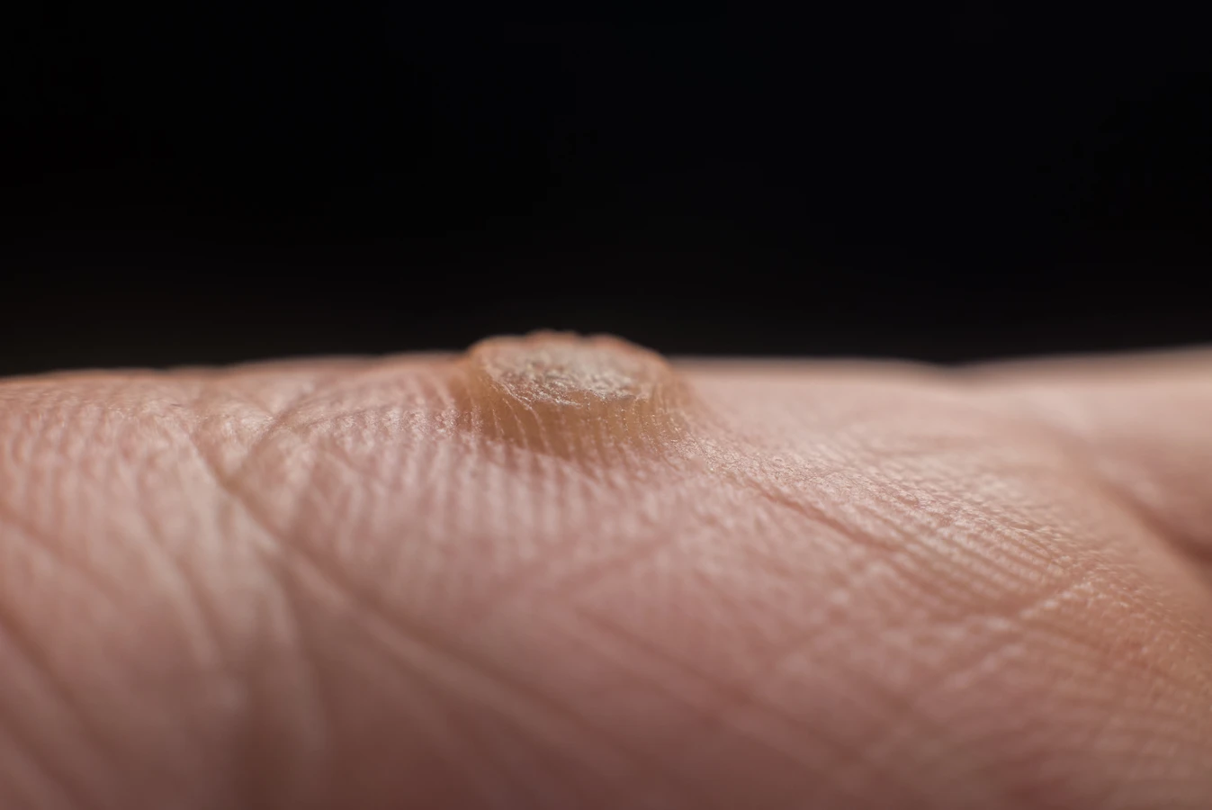 Ile kosztuje usunięcie odcisku u podologa?