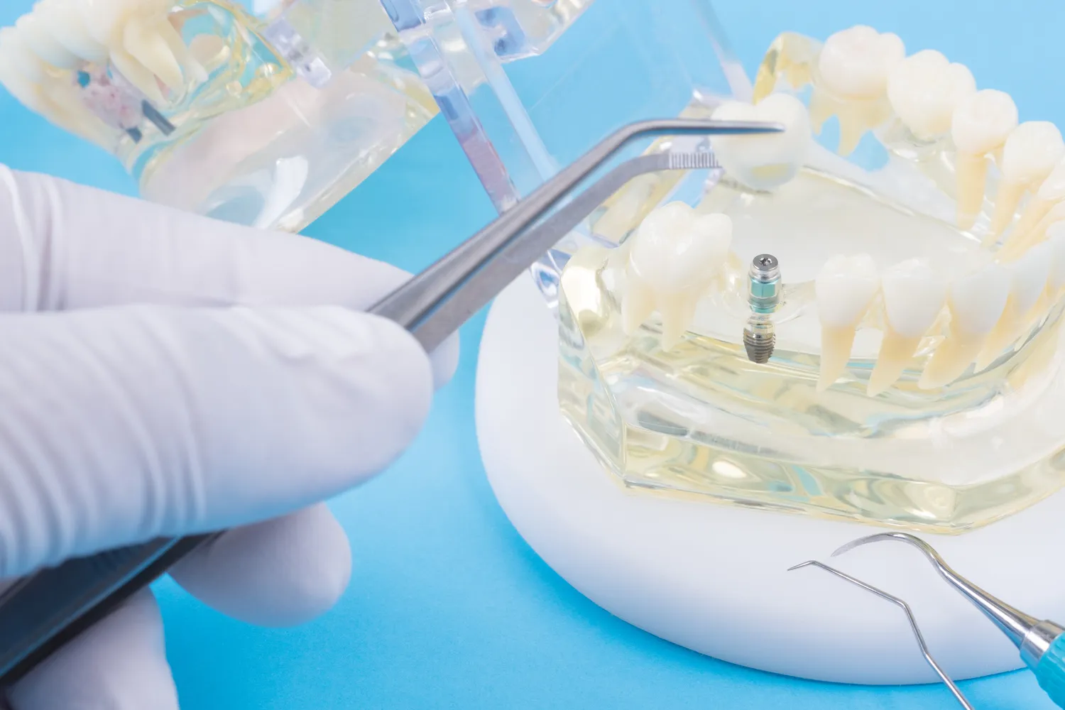 Najlepsze nakładki ortodontyczne Szczecin