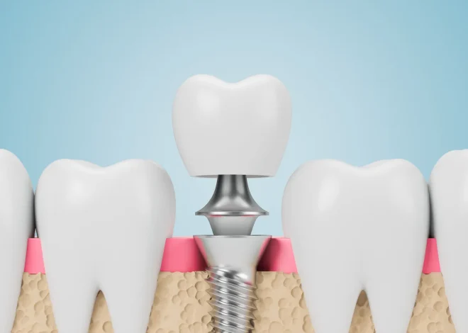 Najlepszy wybielanie zębów Szczecin