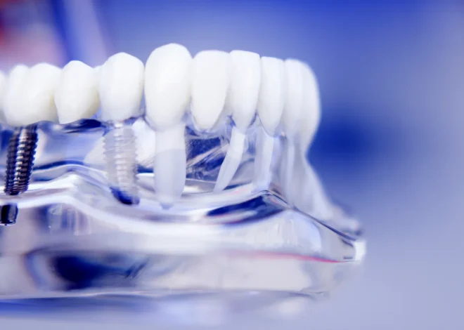 Co należy wiedzieć przed wyborem implantu zęba?