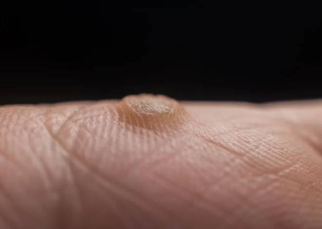 Jak leczyć kurzajki na stopach?