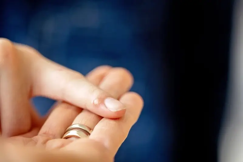 Jak powstają kurzajki?