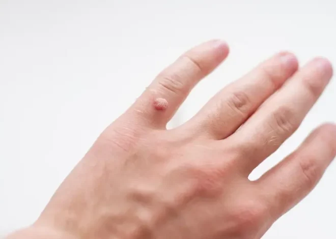 Od czego się robią kurzajki?