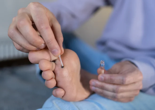 Usuwanie kurzajek Warszawa